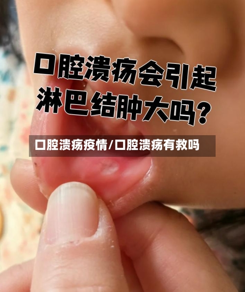 口腔溃疡疫情/口腔溃疡有救吗-第2张图片